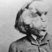 Un Fenómeno con un Alma Hermosa: La historia de Joseph Merrick - El Hombre Elefante