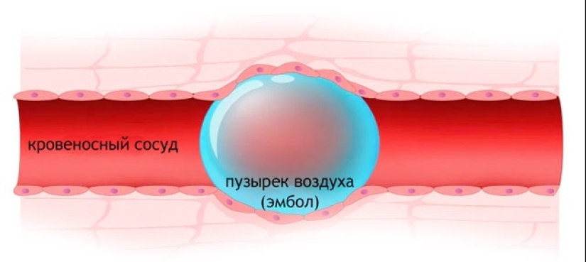 What happens if air gets into a vein? What happens if air gets into a vein?